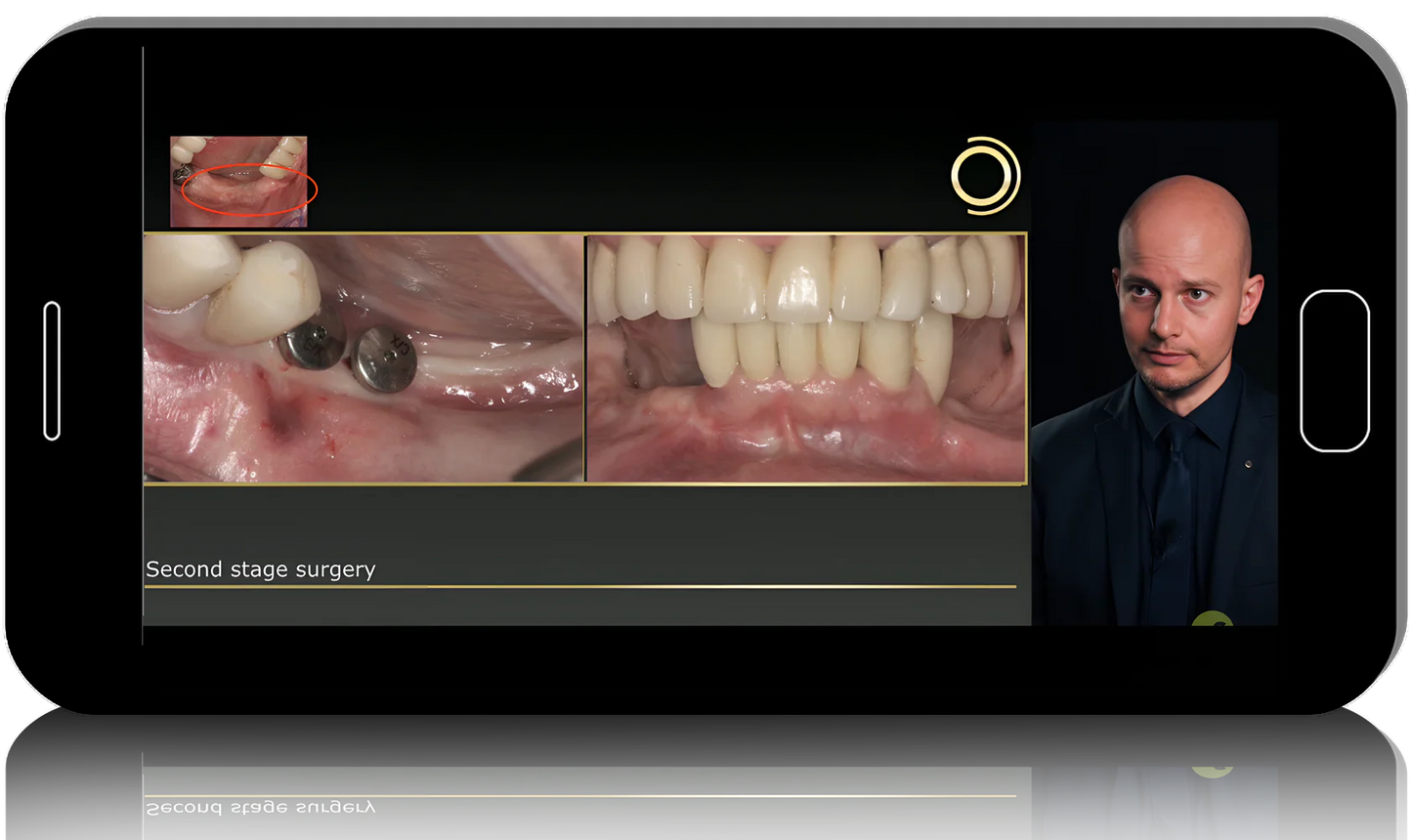 Biological Bone Augmentation