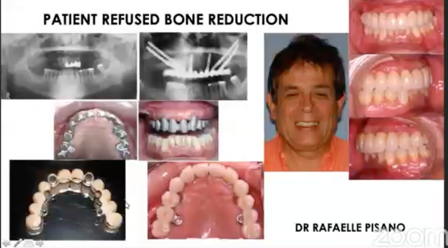 How to Avoid Complications in Zygoma Implant Surgery